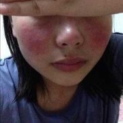 孕期脸变胖（孕妇脸和手也肿了，怎么办）