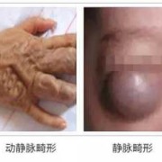 胎儿血管畸形原因（胎儿畸形是什么原因造成的）