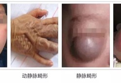 胎儿血管畸形原因（胎儿畸形是什么原因造成的）
