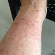 孕期反复湿疹怎么办（孕期湿疹，用盐水清洗，可以吗）