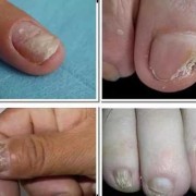 孕期灰指甲（孕期灰指甲怎么治疗最好）