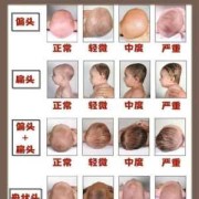 胎儿舟状头（一岁多的宝宝舟状头怎么办）