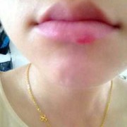 孕妇长疱疹影响胎儿吗（孕中期嘴角长疱疹对胎儿有影响吗）