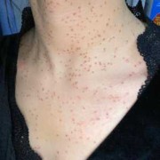 孕期扁平疣（我于怀孕期间在脸，胸部长了一些丝状疣和扁平疣，怎么办）