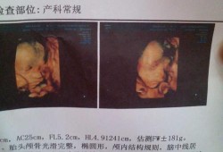 女胎儿彩超图片（女胎儿彩超图片大全）