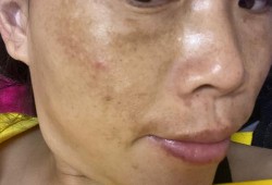 怀孕长斑怎么回事,孕期长雀斑生完会退吗