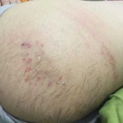 孕期屁股长痘（孕期屁股长痘痘是怎么回事）