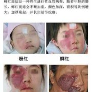 胎儿胎记是什么原因造成,胎儿长胎记是什么原因造成的