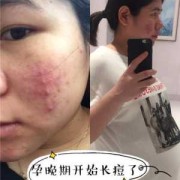 怀孕了能挤痘痘吗,孕期挤痘痘会影响胎儿发育吗