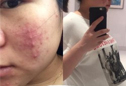 怀孕了能挤痘痘吗,孕期挤痘痘会影响胎儿发育吗