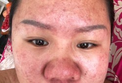 怀孕长痘痘怎么回事,怀孕期间长痘痘是什么原因