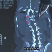 胎儿半椎体主要由什么原因引起,胎儿半椎体畸形图片大全