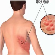 孕妇得了疱疹怎么办,孕期疱疹对胎儿有影响吗