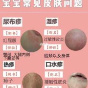 孕期怎么预防婴儿湿疹（怀孕期间一直长湿疹，对宝宝有没有影响）