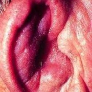 孕期耳朵发炎怎么办（孕期耳朵发炎怎么办啊）