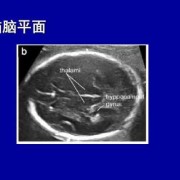 胎儿丘脑是什么（胎儿四维中间帆腔，为什么，严重么）