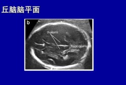 胎儿丘脑是什么（胎儿四维中间帆腔，为什么，严重么）