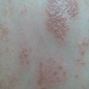 怀孕得了孕期湿疹要怎么办,孕期湿疹图片症状图片
