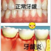 孕妇牙龈发炎怎么办,孕期牙龈炎怎么治疗