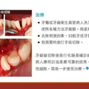 孕期牙龈瘤（牙龈瘤的治疗方法是什么）