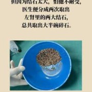 孕妇肾结石伴又肾积水如何治疗?孕中期时候，对胎儿有什么危害,孕妇肾酸痛