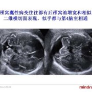 胎儿双脑增宽（胎儿双脑增宽）
