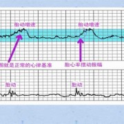 孕13周左右家里胎心仪听胎心总是165-175,胎儿心率175正常吗