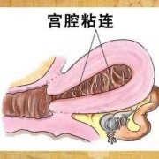 孕期宫腔粘连（宫腔粘连需要治疗吗）