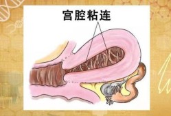 孕期宫腔粘连（宫腔粘连需要治疗吗）