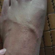 脚面痒,什么原因,孕期脚背痒是什么原因