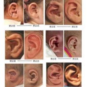 胎儿耳廓（胎儿耳廓形态异常难道就是畸形吗）