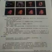 四维彩超心脏有强光点怎么办,24周胎儿左心室强光点怎么办