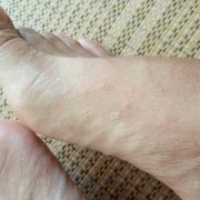 孕期脚痒起小水泡（孕妇手上起水泡很痒对胎儿有影响吗）