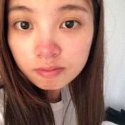 酒糟鼻孕期（孕妇酒糟鼻）