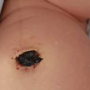 宝宝脐带有点红，搓肚子时发现出血了，怎么办?急急急,胎儿玩脐带妈妈会痛吗
