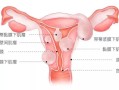 孕期子宫肌瘤（孕期子宫肌瘤可以顺产吗）