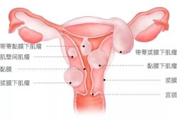 孕期子宫肌瘤（孕期子宫肌瘤可以顺产吗）