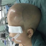 胎儿脑积水的原因（宝宝外部脑积水怎么办，给宝宝怎样治疗好呢）