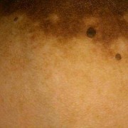 怀孕后期乳头周围乳晕上有疙瘩怎么回事,孕期长肉疣的原因是什么