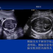 胎儿双侧脑室脉络丛内均见无回声怎么回事,胎儿双侧脉络丛是哪里