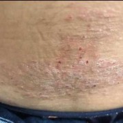 治疗孕期湿疹小妙招（治疗孕期湿疹小妙招有哪些）