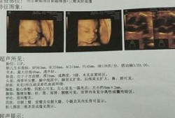 胎儿心脏三维超声心动图是什么,胎儿三维超声检查是什么