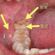 怀孕期间可以拔智齿吗（怀孕长智齿怎么办）