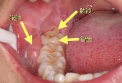 怀孕期间可以拔智齿吗（怀孕长智齿怎么办）