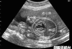 胎儿心脏畸形（造成胎儿心脏畸形的原因是什么）