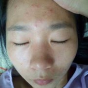 怀孕期间长痘痘怎么治（怀孕期间长痘痘怎么治疗）