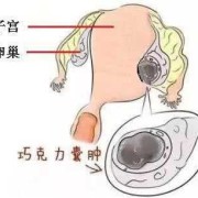 孕期囊肿增大（孕期囊肿增大肚子是不是也特别显怀?）