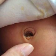 炎症对胎儿的影响（刚出生的婴儿炎症是怎样的？有什么表现？儿子刚出生，好像有炎症）