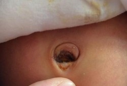 炎症对胎儿的影响（刚出生的婴儿炎症是怎样的？有什么表现？儿子刚出生，好像有炎症）