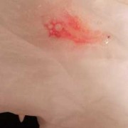 孕期呕吐出血（孕期呕吐出血是怎么回事）